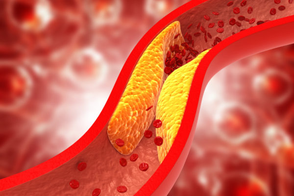 Omega 3 May Benefit Atheroslcerosis